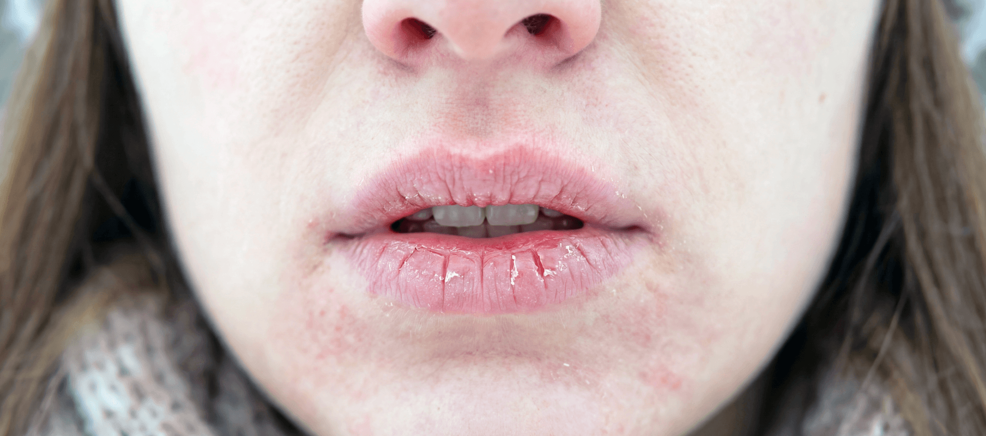 usta pękają od wiatru mrozu